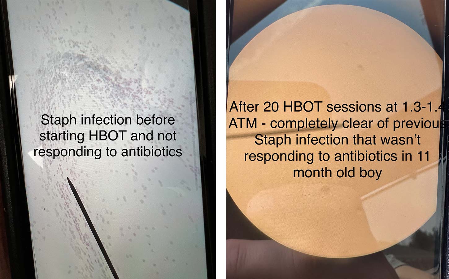 staph infection before and after hbot therapy